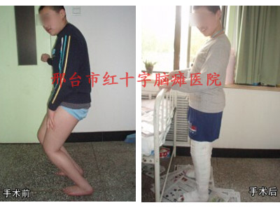 微創(chuàng)矯形手術(shù)治療小兒腦癱哪里效果好？邢臺腦癱醫(yī)院